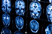 Participate in a Stanford Chronic Pain Study and Receive $200 Cash 3